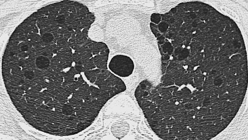 Doença pulmonar cística
