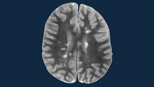 Esclerose múltipla 2.0