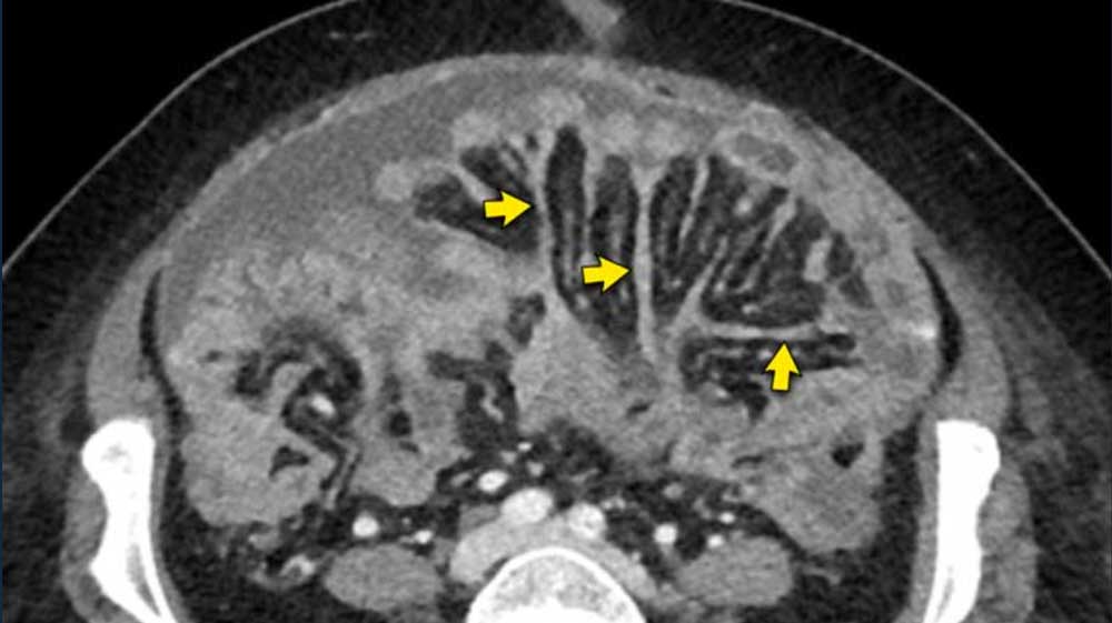Carcinomatose peritoneal