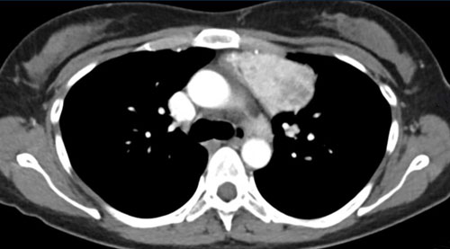 Massas tímicas e imitações