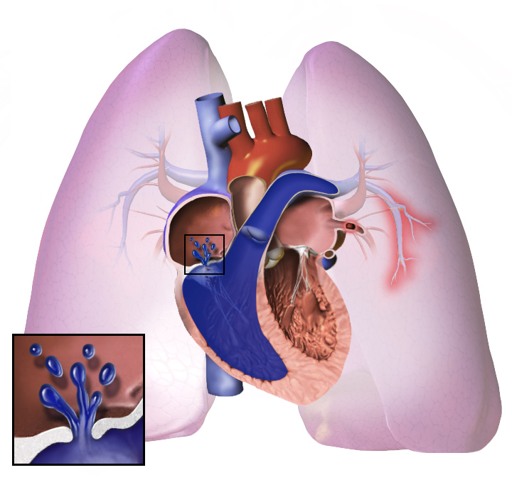 Hipertensão pulmonar