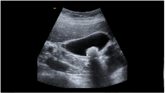 Ultrassonografia de cólica biliar