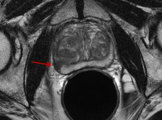 Câncer de próstata - PI-RADS v2.1